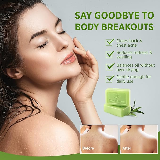 Roycederm Tea Tree Soap for Face & Body Acne, Athlete's Foot, Tinea, Folliculitis Ringworm Jock Itch - Pack of 2
