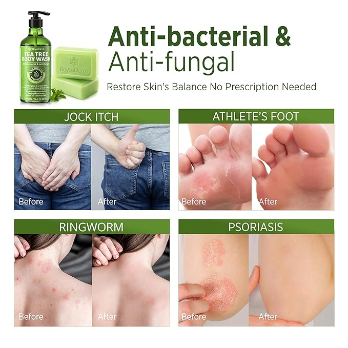 Roycederm Tea Tree Antifungal Body Wash & Soap: Bundle for Body Odor, Back Acne, Folliculitis, Tinea Versicolor, Jock Itch, Athlete’s Foot, and Ringworm - Cleansing with tea tree oil for Men & Women