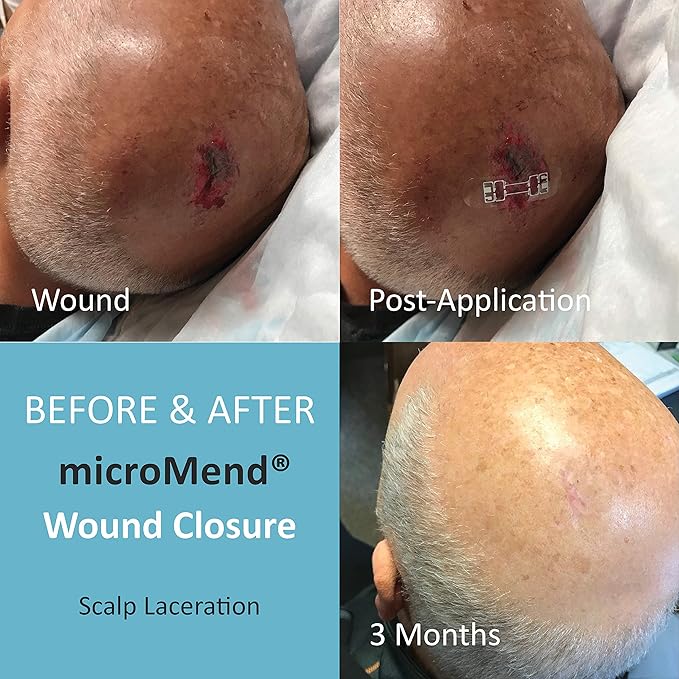Emergency Wound Closures Surgical Quality Laceration Repair Without Stitches - Think Ahead - Be Prepared - Add to Your First Aid Kit, Camping Gear (Multi Pack - 3 Packs of 2 Medium Devices)